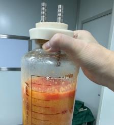 毕节水动力吸脂手术要做多久？
